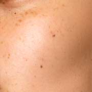 Dark Spots